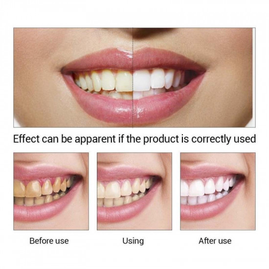 Teeth Whitening
